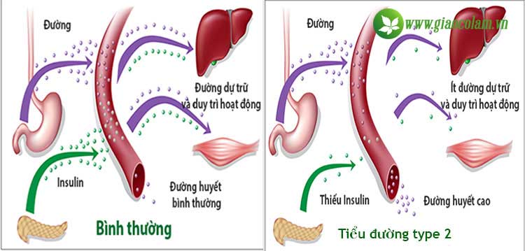 tieu-duong-type-2-la-gi